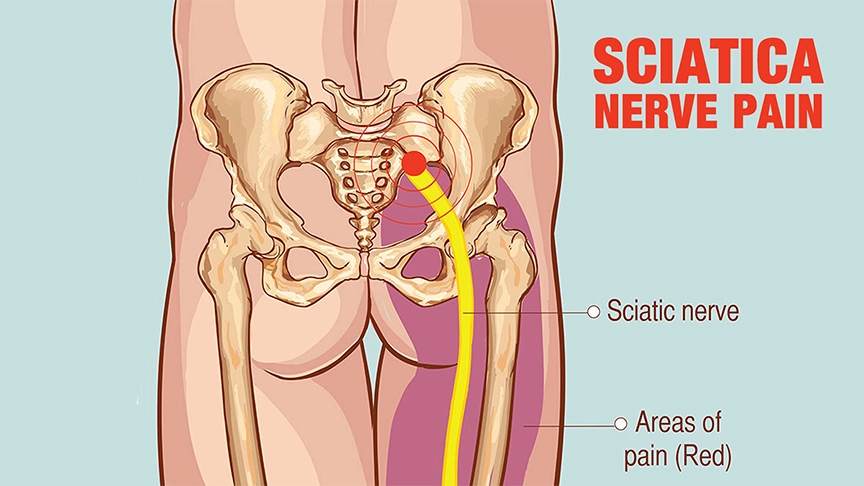 How Massage Therapy And Chiropractic Can Relieve Sciatica Pain